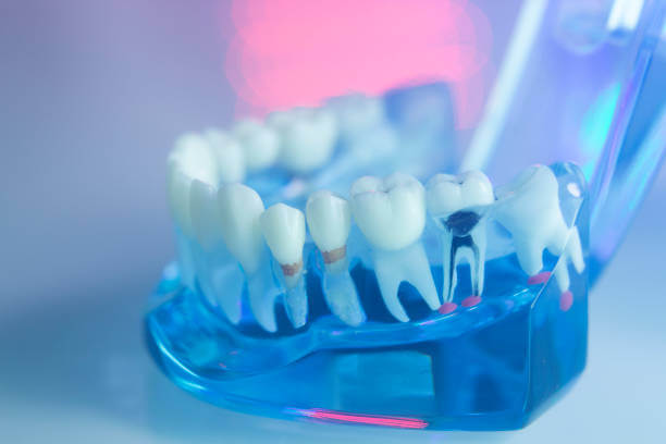 Root Canal vs Dental Implant Costs in Wisconsin
