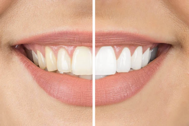 Waukesha Teeth Whitening Before and After
