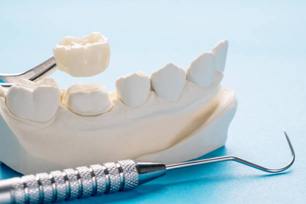 Dental crown treatments at Tanty Dental