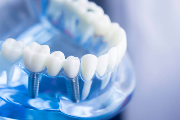 Replace multiple missing teeth with Waukesha dental implants
