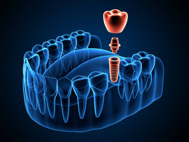 Dental Implant Installation Procedure