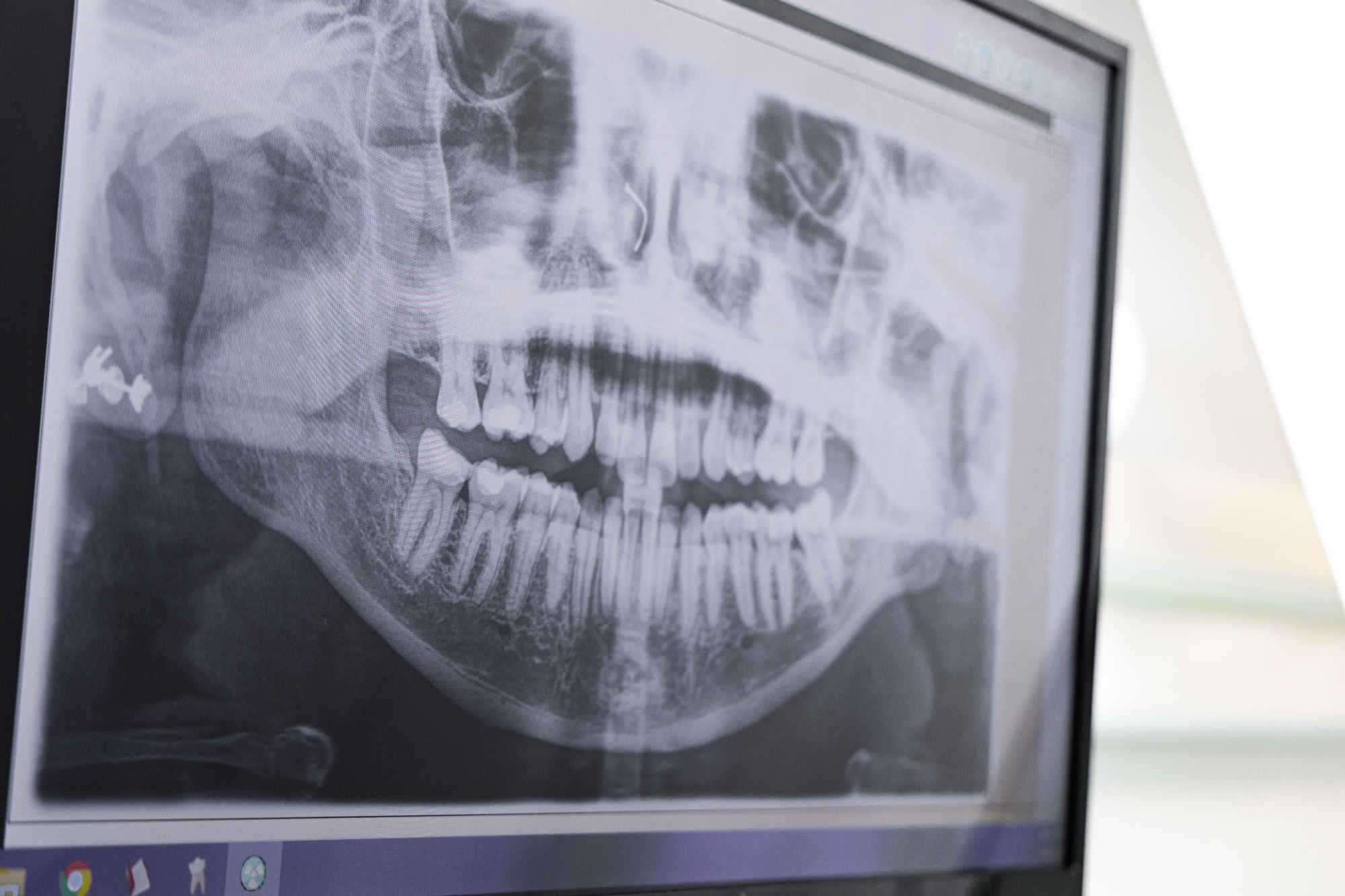 Dental Bonding X-ray