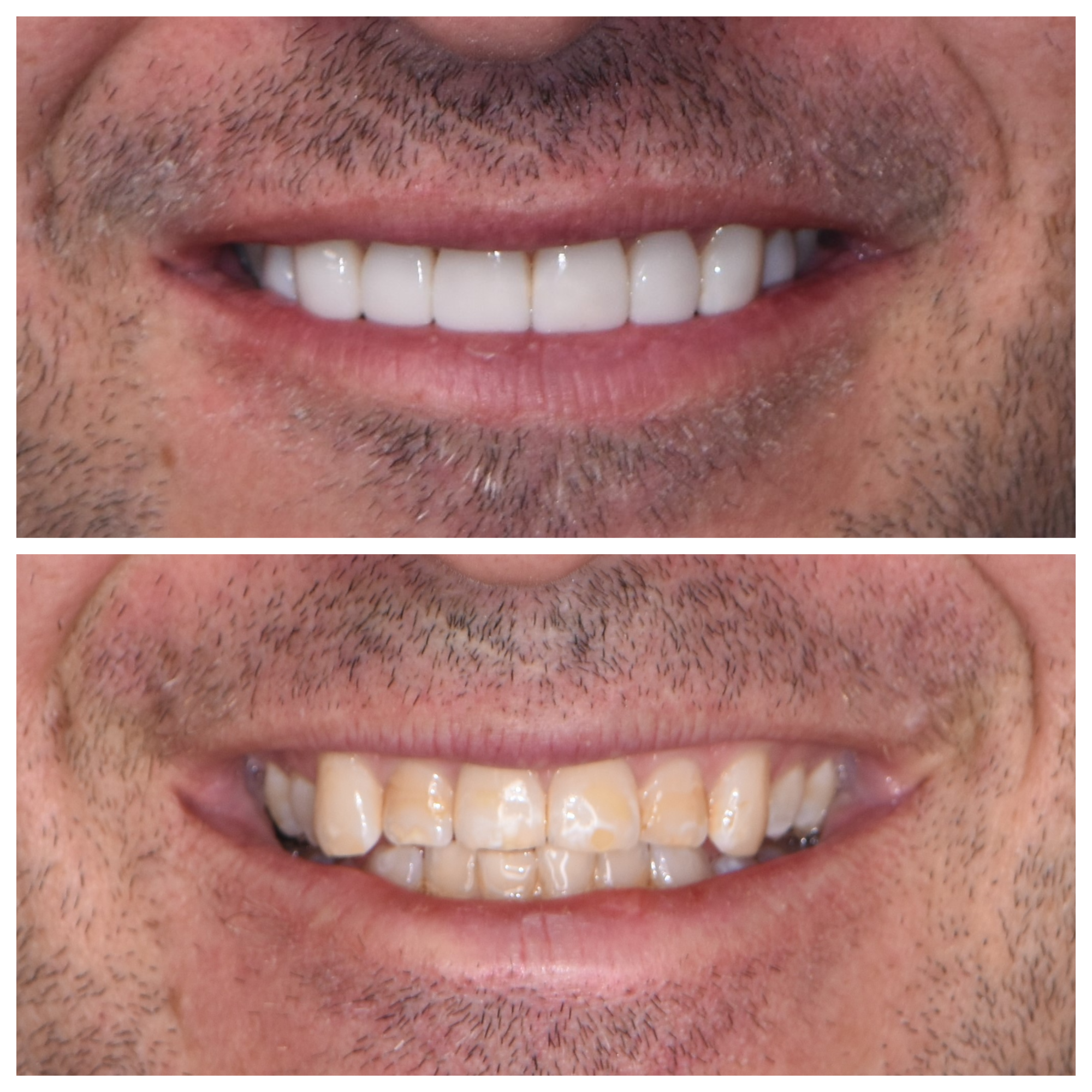 Porcelain veneers will whiten your smile and boost your confidence